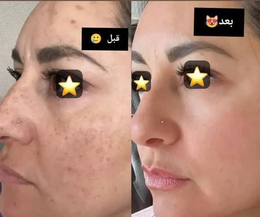 نتیجه درمان لک